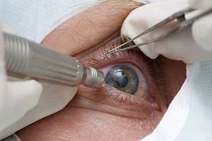 Первую в мире операцию по пересадке сетчатки глаза из стволовых клеток провели в Японии